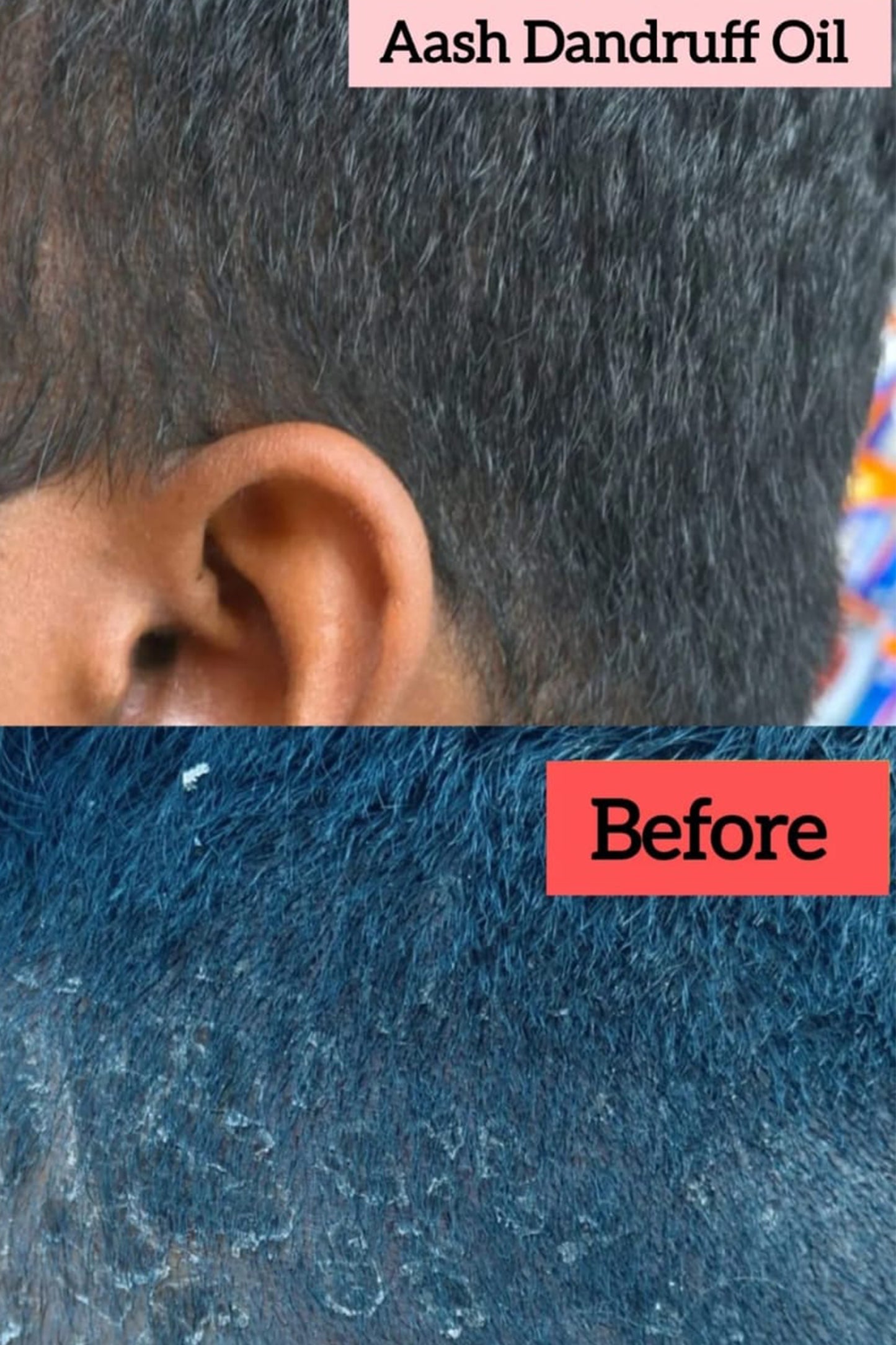Anti Dandruff Hair Oil