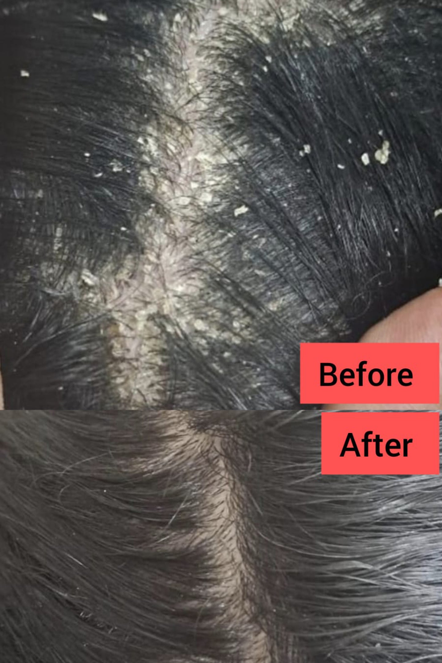 Anti Dandruff Hair Oil