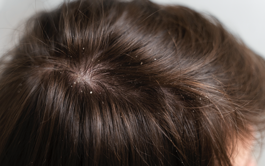 The Ultimate Guide to Dandruff Oils: Combatting Flakes Naturally